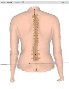 Scoliosis of the back, contour map - Stock Image - M260/0362 - Science  Photo Library