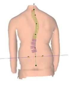 Scoliosis Before And After - Align Physical Therapy Clinic in Lehi