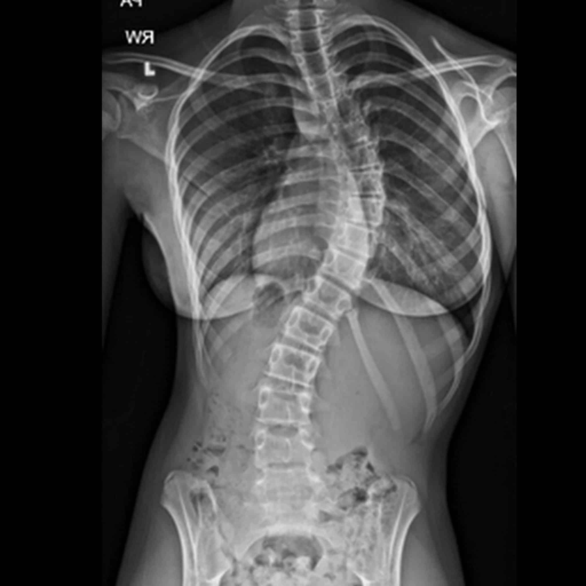 Scoliosis x ray wide scaled