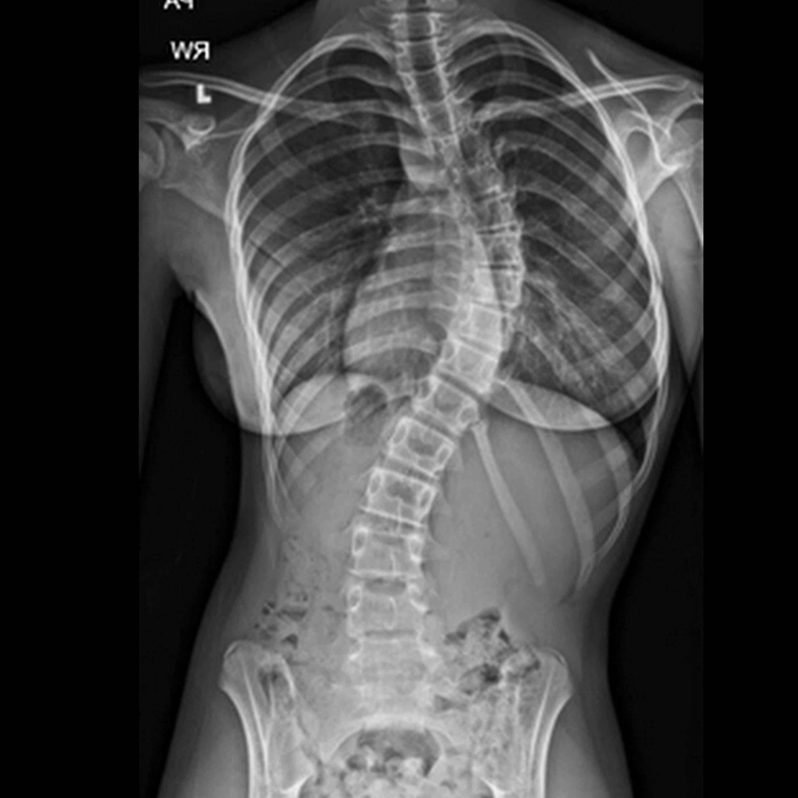 Scoliosis x ray wide scaled