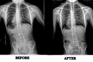Scoliosis treatment before and after