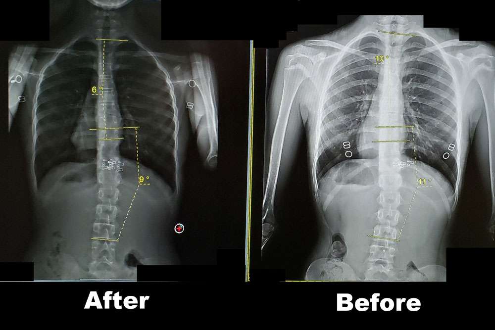 Scoliosis Before And After - Align Physical Therapy Clinic in Lehi, Utah