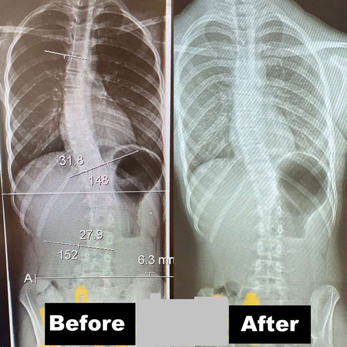 Scoliosis Before And After - Align Physical Therapy Clinic in Lehi, Utah