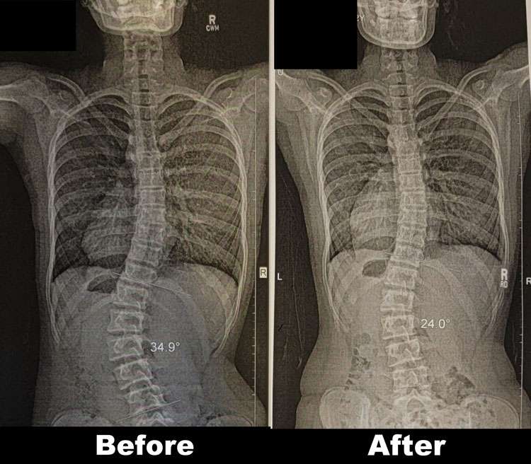 Schroth Method Before And After Align Therapy Clinic In Lehi Utah