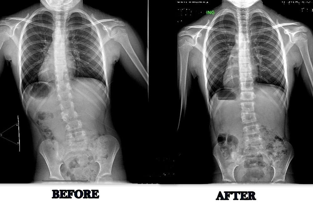 Scoliosis Before And After - Align Physical Therapy Clinic in Lehi