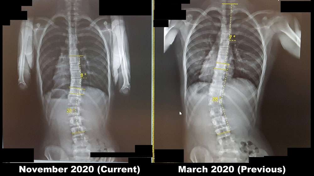 Scoliosis Before And After - Align Physical Therapy Clinic in Lehi