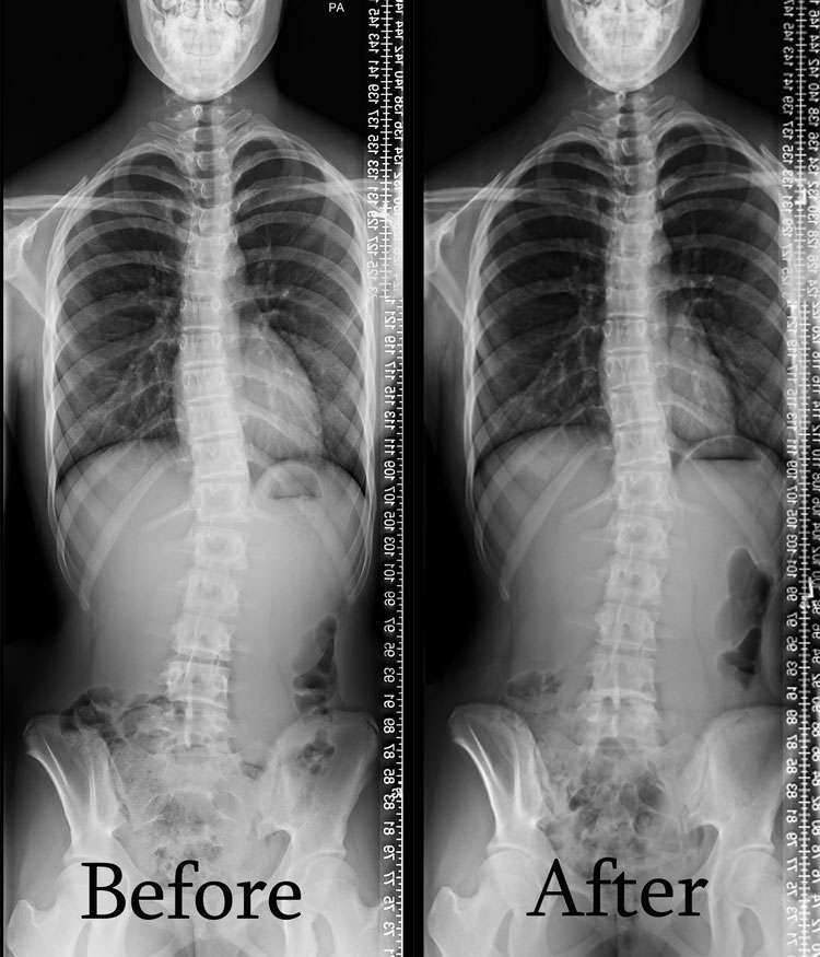 Scoliosis Before And After - Align Physical Therapy Clinic in Lehi, Utah