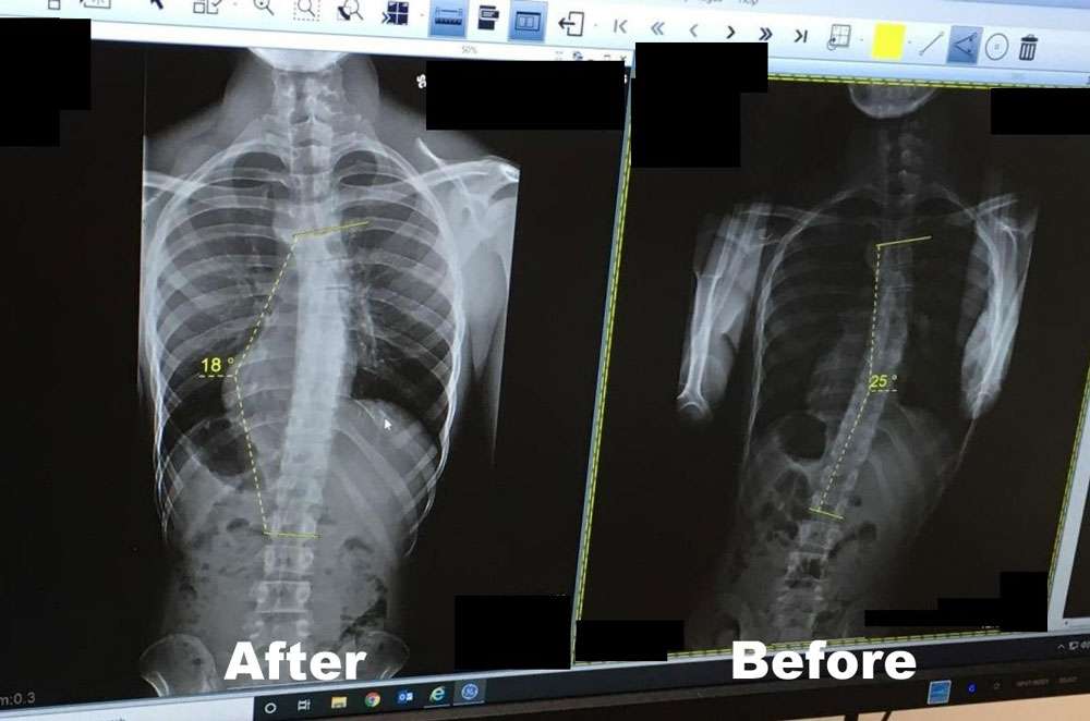 Scoliosis Before And After - Align Physical Therapy Clinic in Lehi