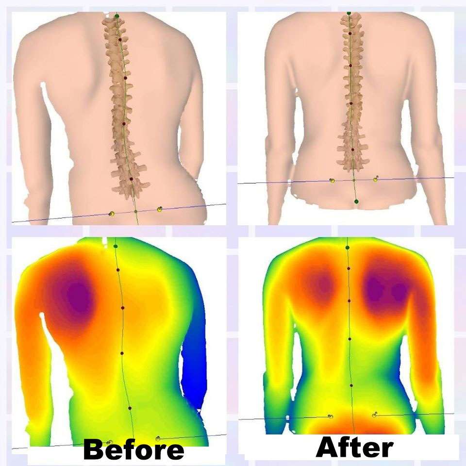 Scoliosis Before And After - Align Physical Therapy Clinic in Lehi