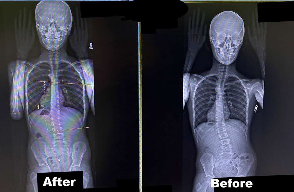 Scoliosis Before And After - Align Physical Therapy Clinic in Lehi, Utah