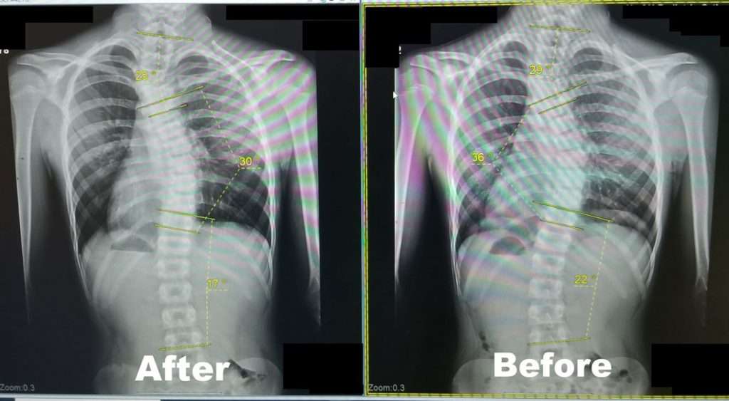 Scoliosis Before And After - Align Physical Therapy Clinic in Lehi, Utah